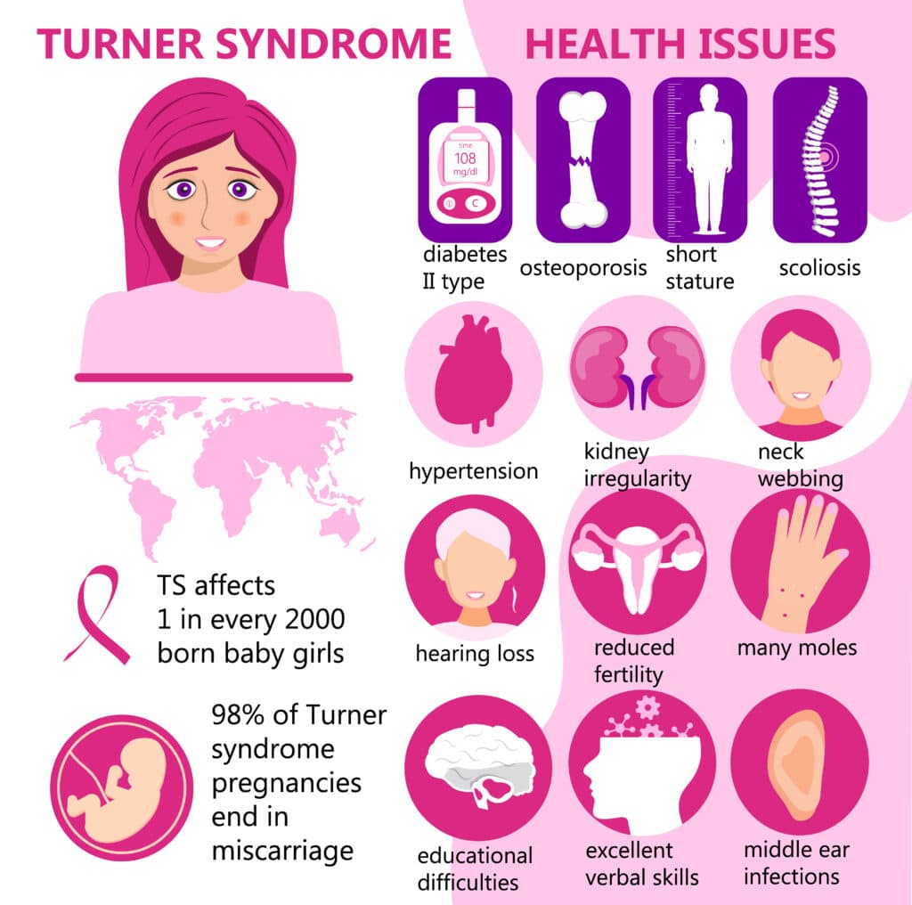 Infographic on Turner Syndrome: features a female illustration, health issues like diabetes, hearing loss, and more. Statistics show 1 in 2000 female births affected, with high miscarriage rate.